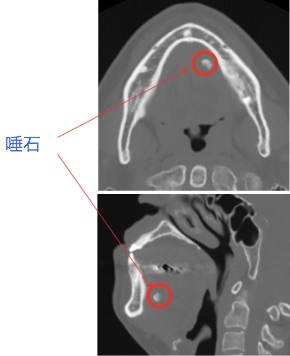 顎下腺唾石症 (がっかせんだせきしょう）  診療ピックアップ  弁財天 