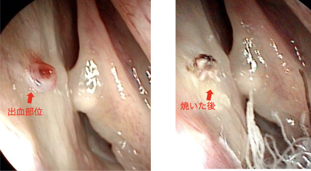 鼻出血の止血 びしゅっけつのしけつ 診療ピックアップ 弁財天耳鼻咽喉科クリニック 愛媛県西条市